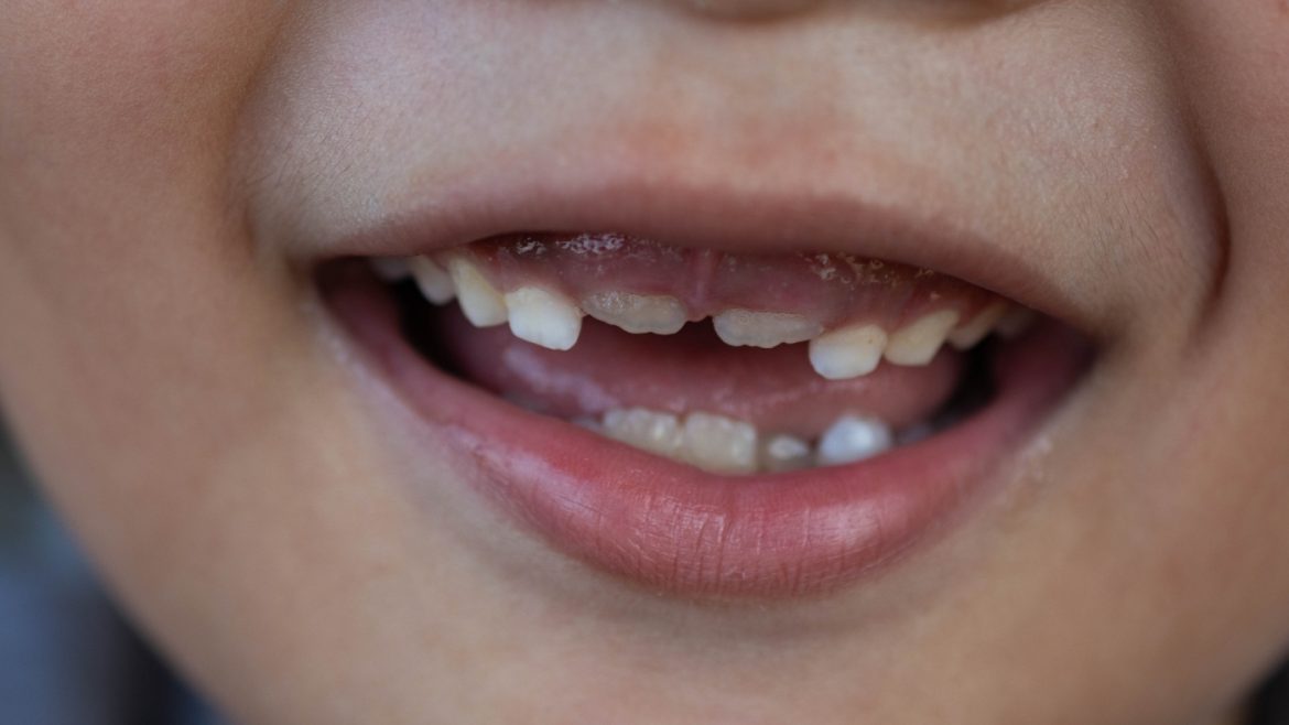 FDA Bans Fluoride Supplements for Kids, Dentists Lose Key Cavity-Fighting Tool