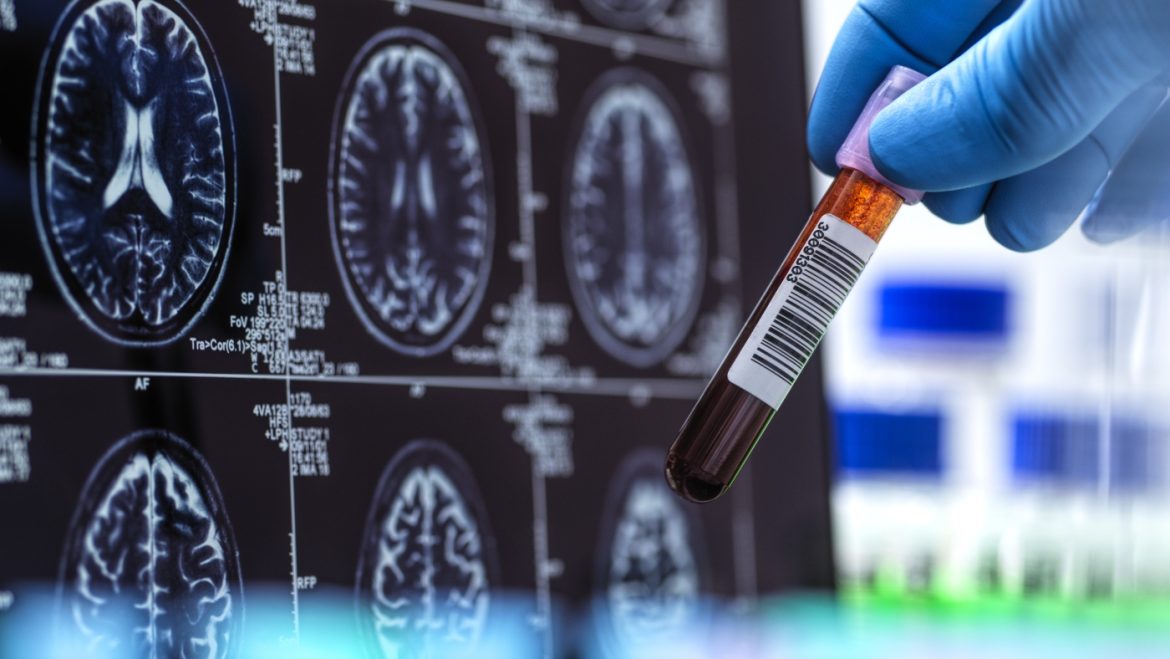 Revolutionizing Alzheimer’s Diagnosis: The First FDA-Cleared AI-Powered Blood Test